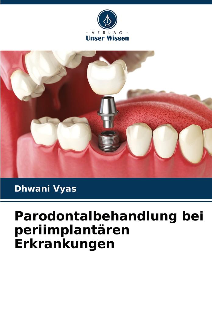 Parodontalbehandlung bei periimplantären Erkrankungen