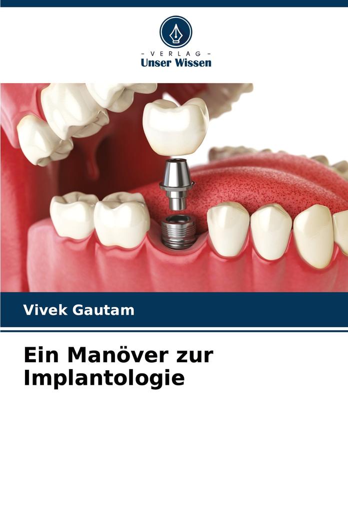 Ein Manöver zur Implantologie