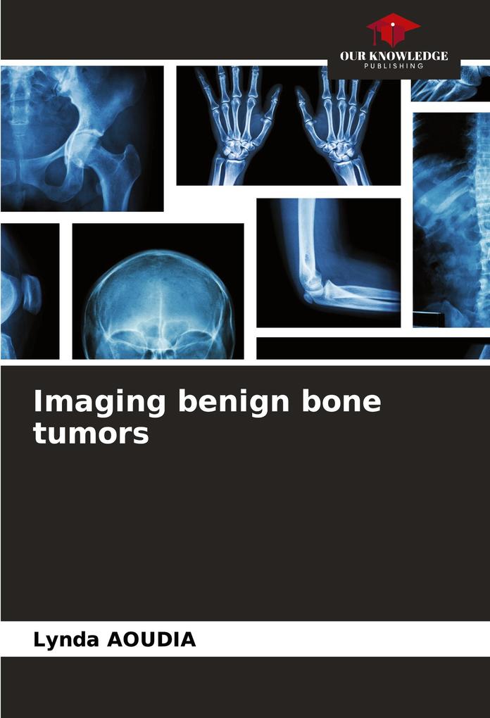 Imaging benign bone tumors