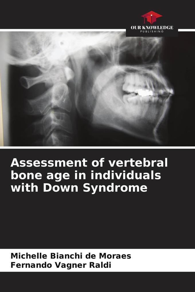 Assessment of vertebral bone age in individuals with Down Syndrome