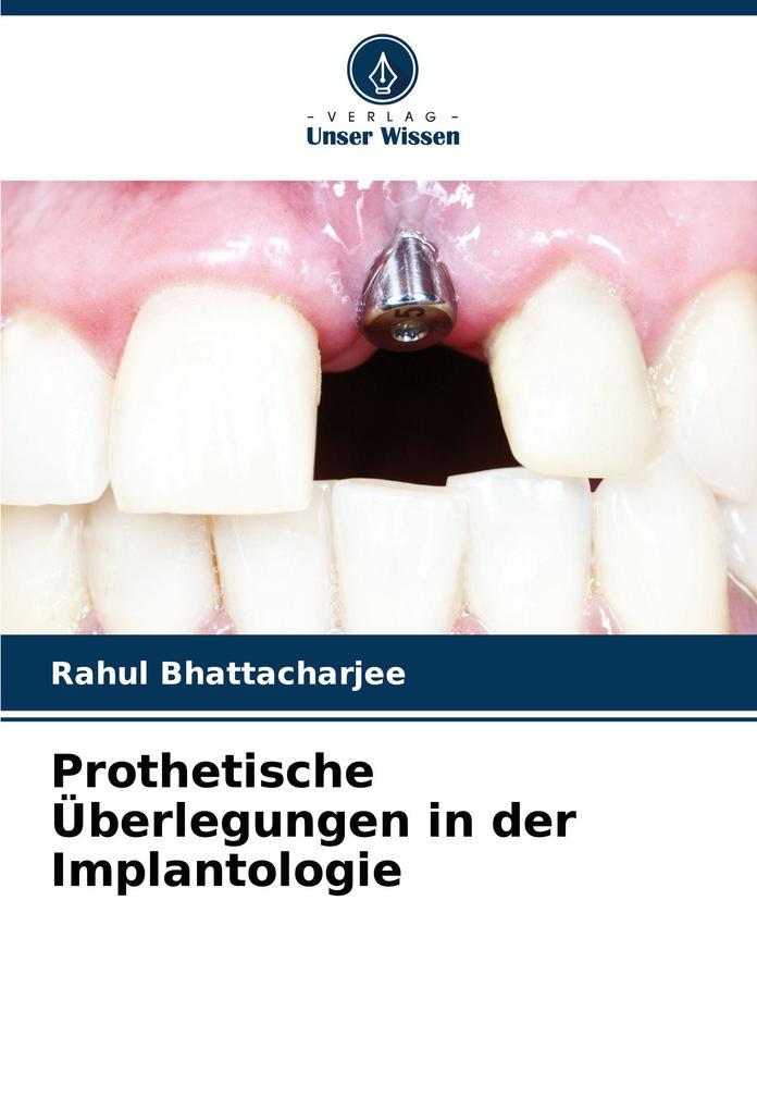 Prothetische Überlegungen in der Implantologie