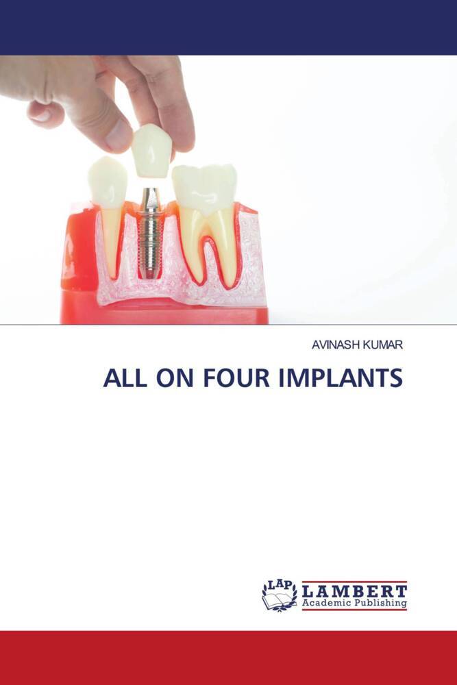 ALL ON FOUR IMPLANTS