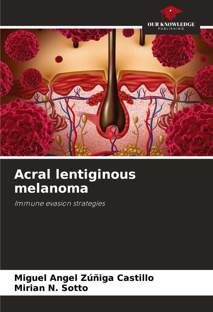 Acral lentiginous melanoma