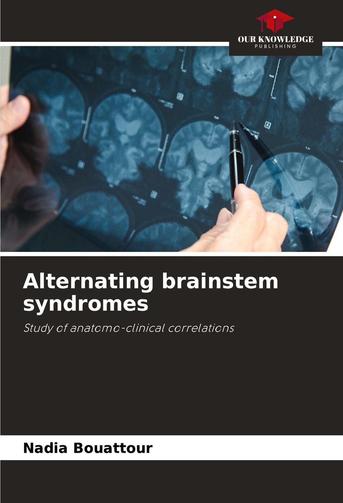Alternating brainstem syndromes