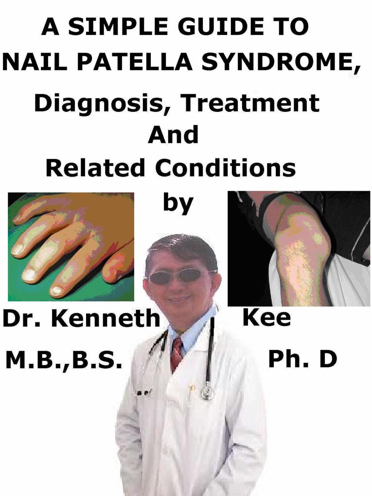 A Simple Guide to Nail Patella Syndrome Diagnosis Treatment and Related Conditions