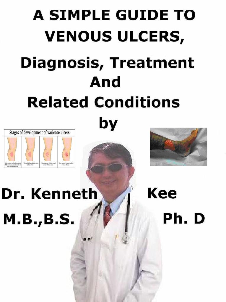 A Simple Guide to Venous Ulcers Diagnosis Treatment and Related Conditions