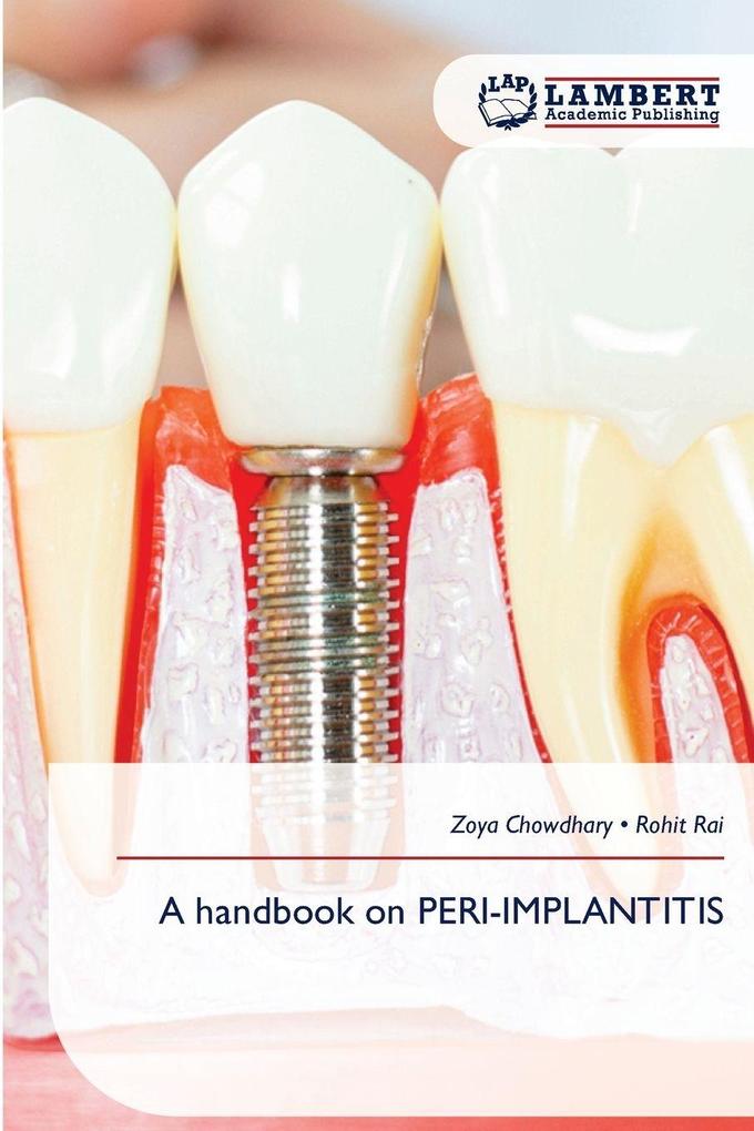 A handbook on PERI-IMPLANTITIS