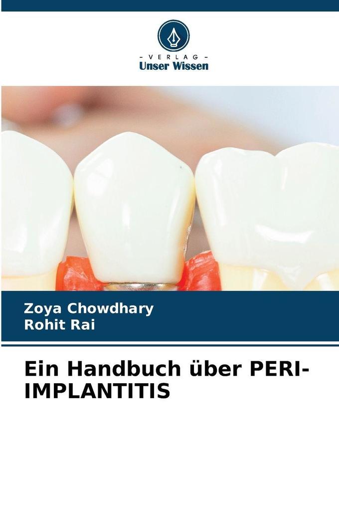 Ein Handbuch über PERI-IMPLANTITIS