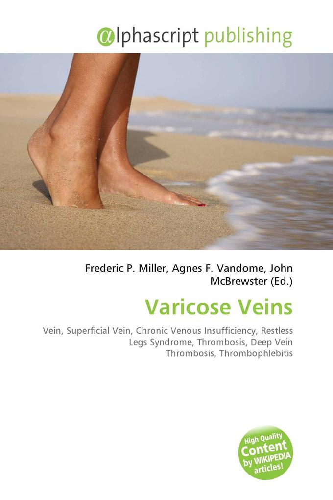 Varicose Veins