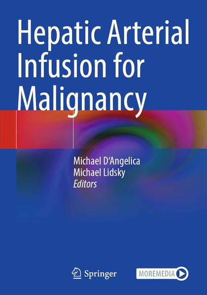 Hepatic Arterial Infusion for Malignancy