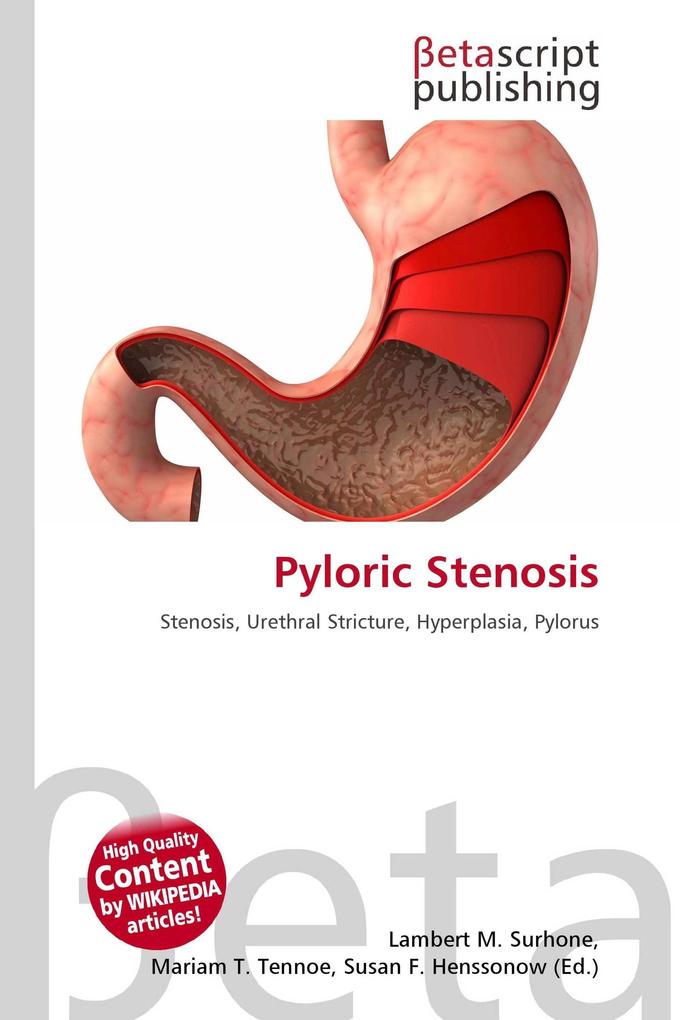 Pyloric Stenosis