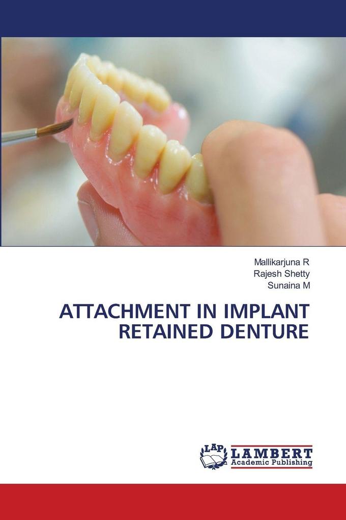 ATTACHMENT IN IMPLANT RETAINED DENTURE