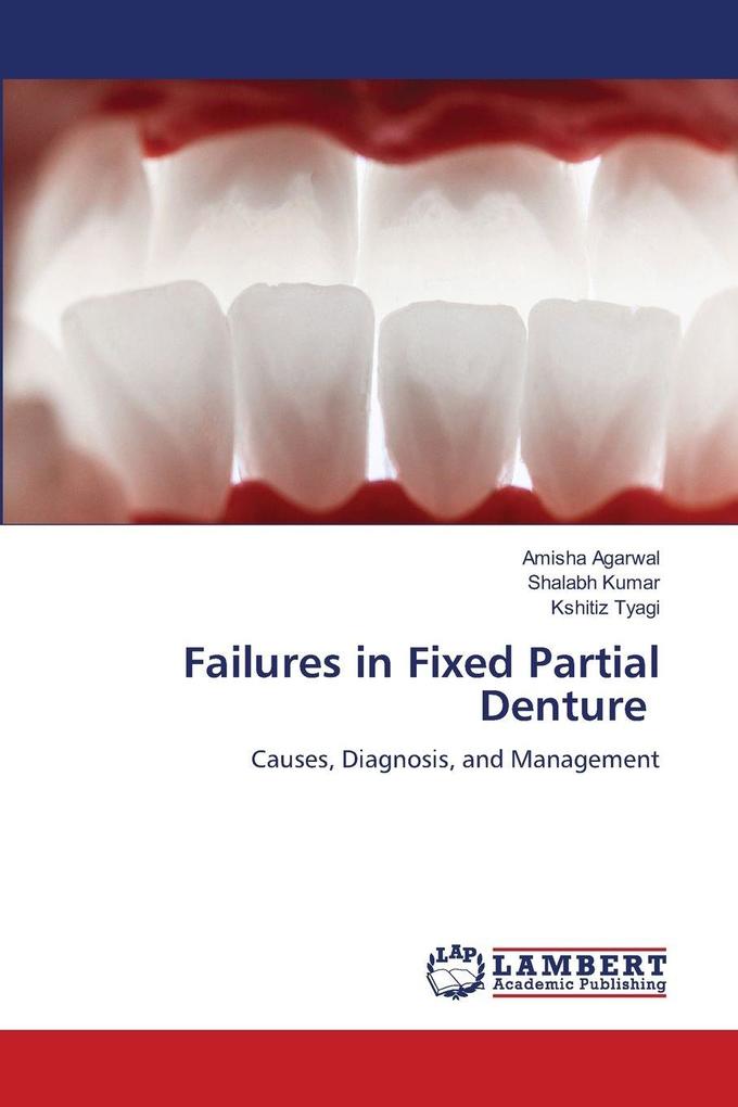 Failures in Fixed Partial Denture