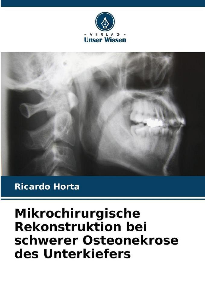 Mikrochirurgische Rekonstruktion bei schwerer Osteonekrose des Unterkiefers