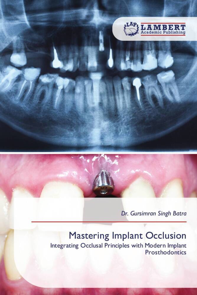 Mastering Implant Occlusion