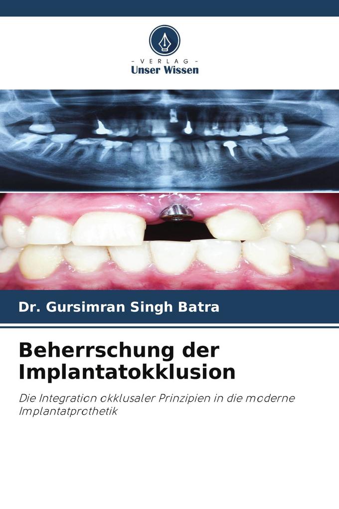 Beherrschung der Implantatokklusion