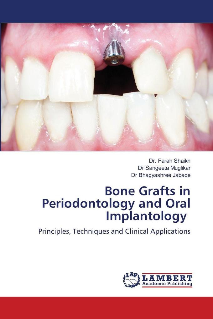 Bone Grafts in Periodontology and Oral Implantology