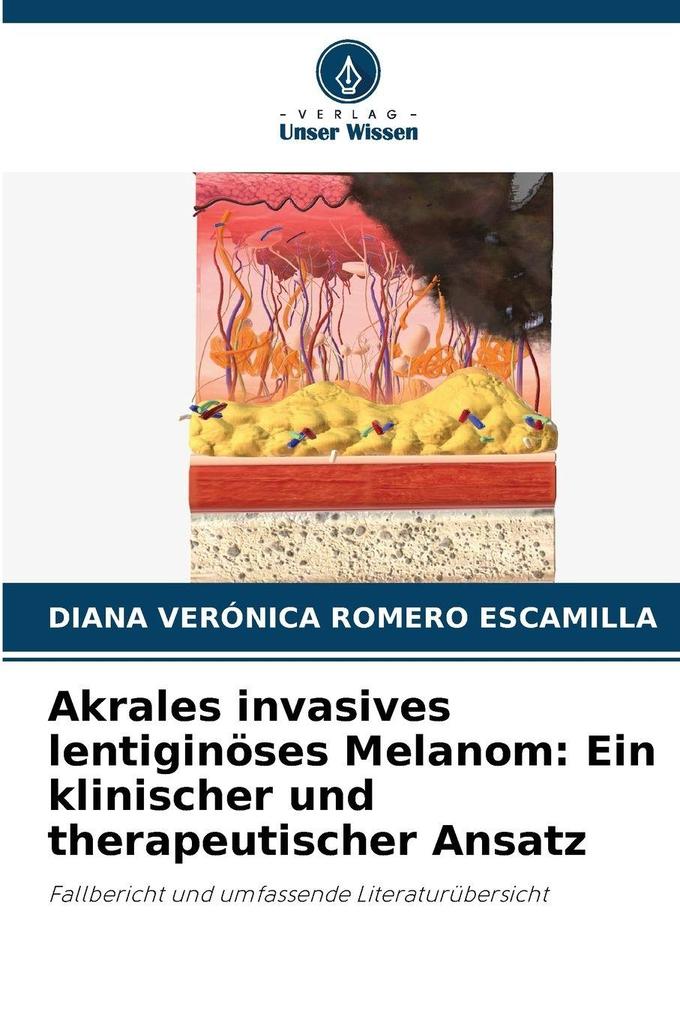 Akrales invasives lentiginöses Melanom: Ein klinischer und therapeutischer Ansatz