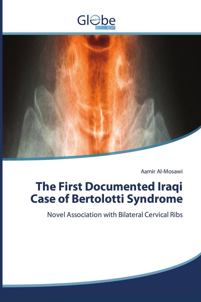 The First Documented Iraqi Case of Bertolotti Syndrome