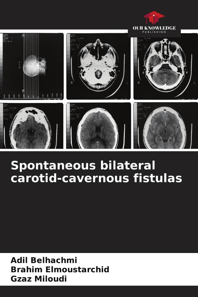 Spontaneous bilateral carotid-cavernous fistulas