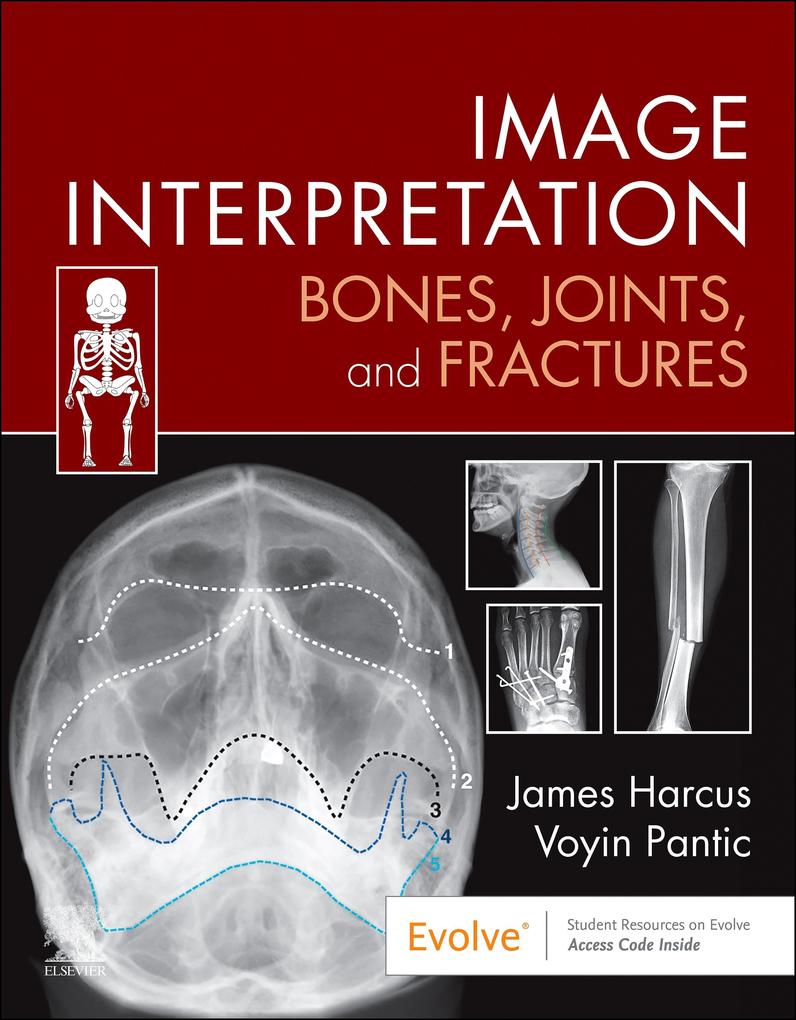 Image Interpretation: Bones Joints and Fractures - E-Book