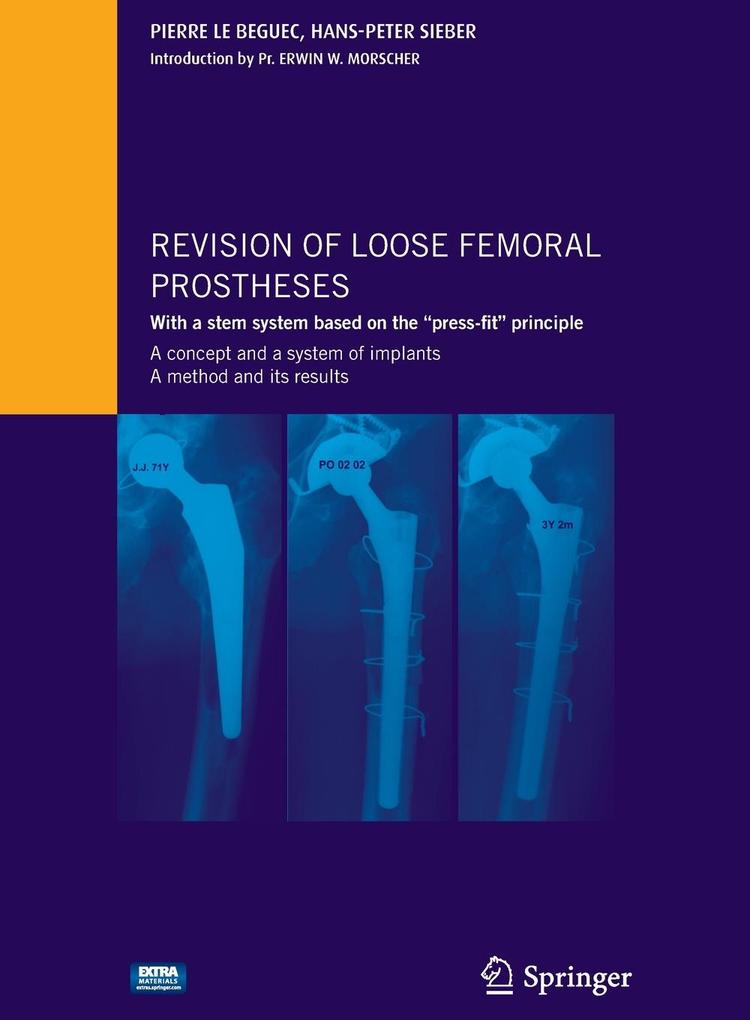 Revision of Loose Femoral Prostheses with a Stem System Based on the Press-Fit Principle